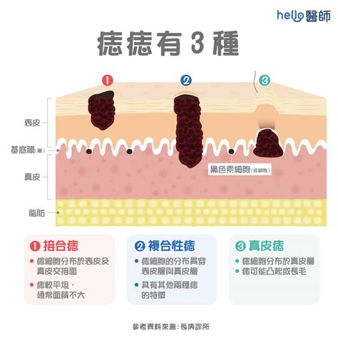 身體長痣的原因